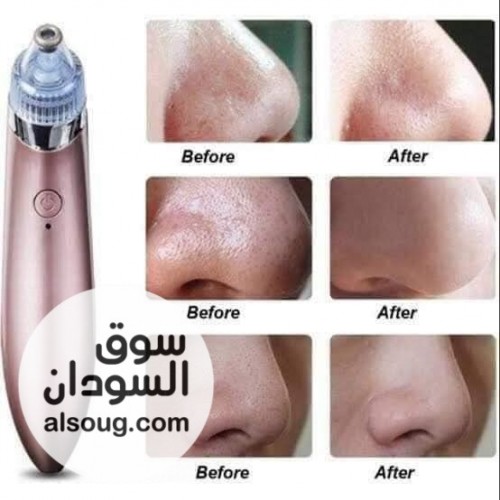 جهاز شفط الدهون  - صورة رقم 1