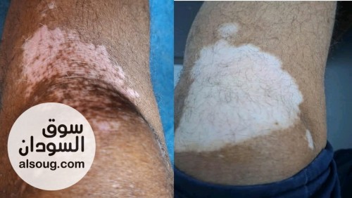 مجموعة علاج البهاق 