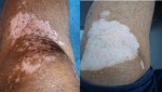 مجموعة علاج البهاق 