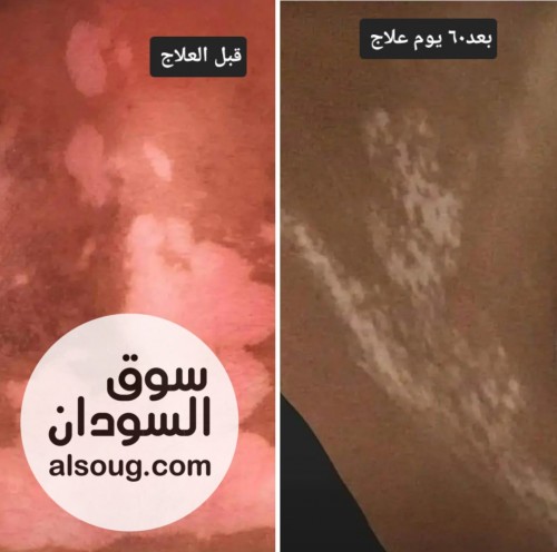 مجموعة علاج البهاق.