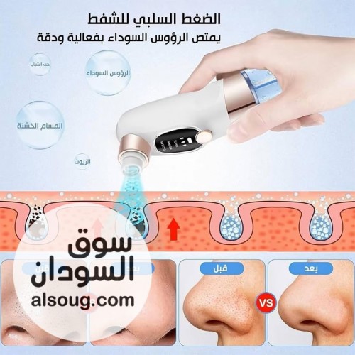 *جهاز شفط الدهون المائي* 
 
جهاز Anluomania لشفط وإزالة الرؤوس السوداء